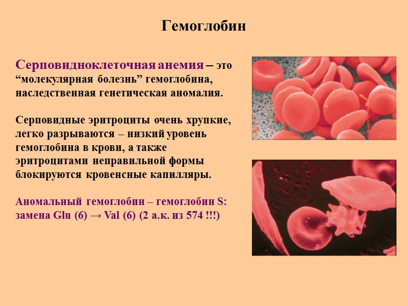 Гемоглобин Серповидноклеточная анемия – это  “молекулярная болезнь” гемоглобина, наследственная генетическая аномалия.  Серповидные